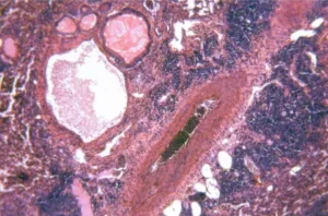 Amianto e tumori - mesotelioma e altre patologie Avvocato Rita Lasagna | risarcimento danno biologico | nl5 | amianto | cancro