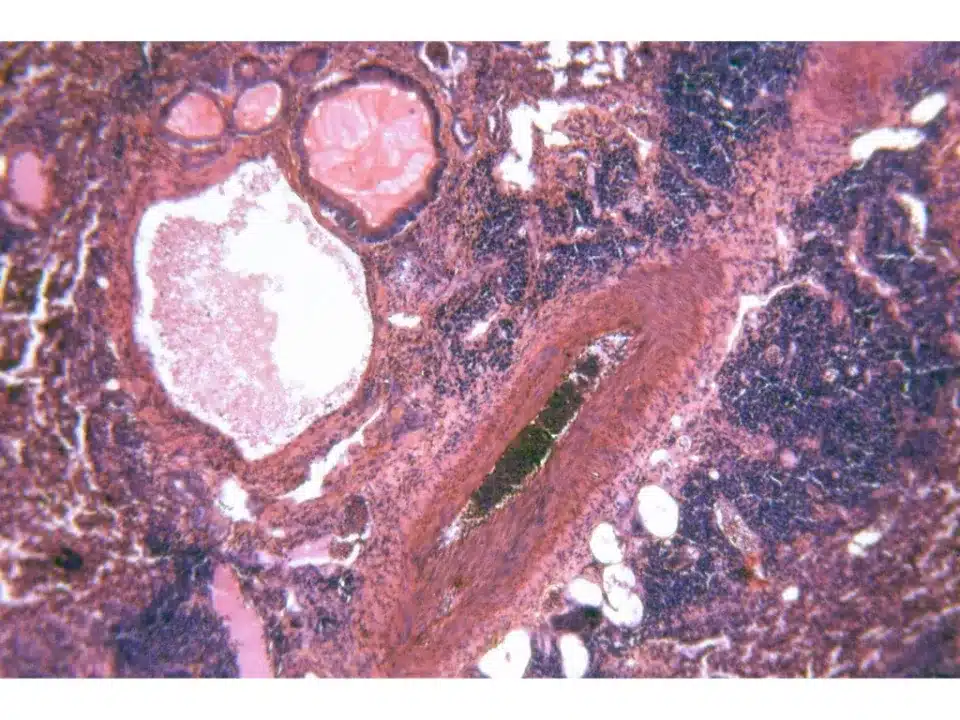 Amianto e tumori - mesotelioma e altre patologie amianto | Avvocato Rita Lasagna | cancro | danno biologico | malattia professionale